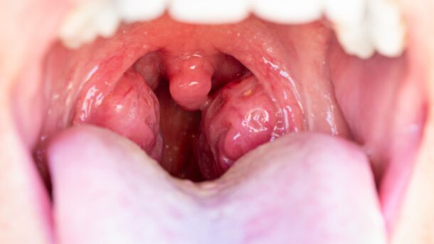 tonsillectomy by dr. dev roy